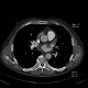 Thrombosis of the left atrial appendage: CT - Computed tomography